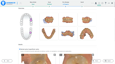 XL013 Dental Aoralscan 3